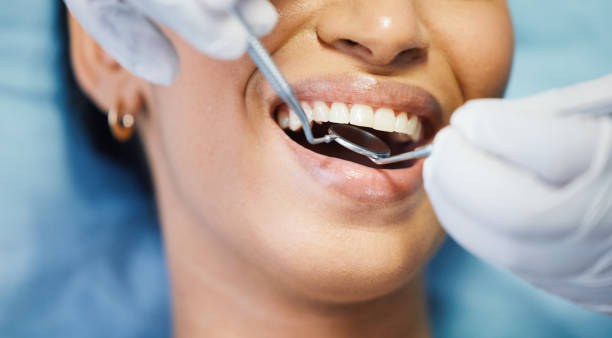 Best Emergency Dentist for Lost Fillings or Crowns in Utica, OH